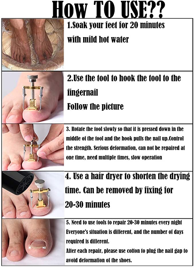 أداة تصحيح أظافر القدم واليد لتعود لوضعها الطبيعي والتخلص من الألم